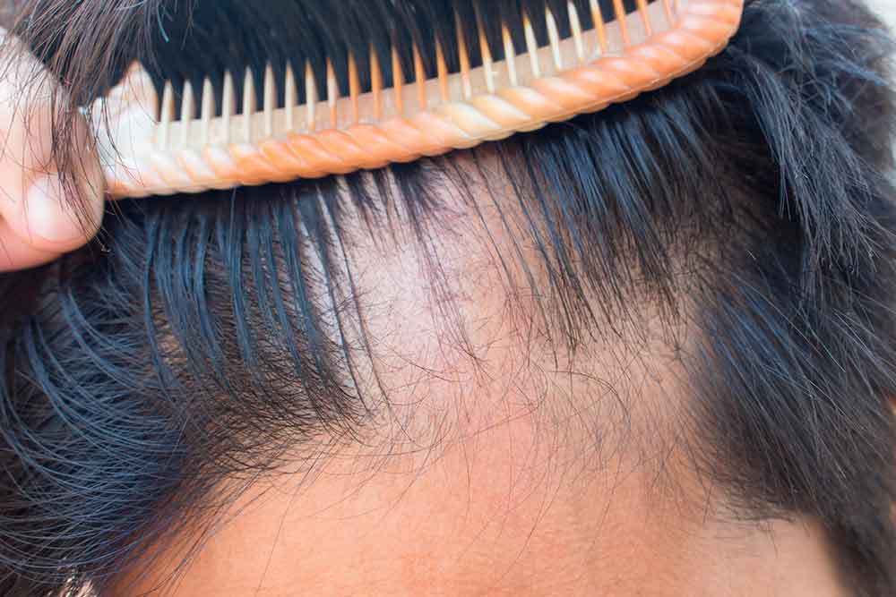 Trichotillomania (hair pulling disorder) The causes and symptoms...