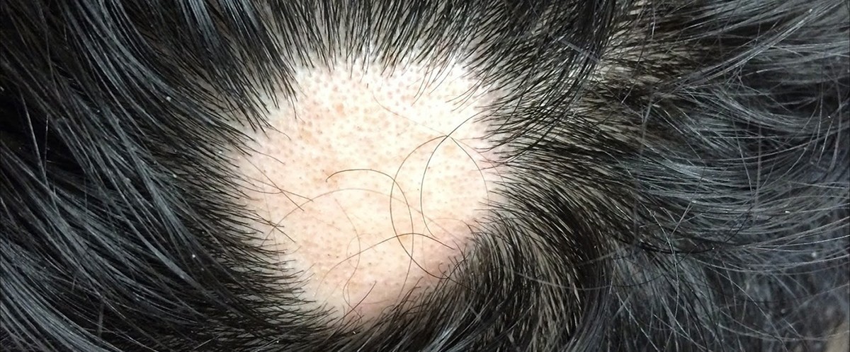 pelade alopecie en aire