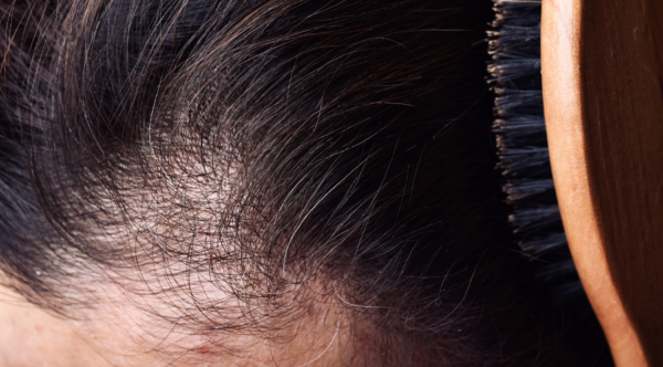 chute de cheveux, signaux important et conseils